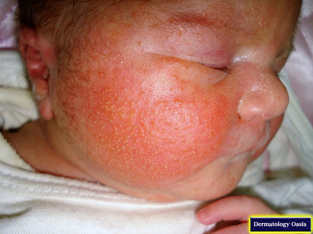 Dermatite neonatale - mammaepapa.it