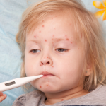 Kızamık’tan Ölenlerin Sayısı Arttıkça Artıyor!