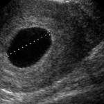 Boş Gebelik Nasıl Anlaşılır?