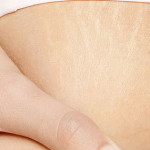 Hamilelikte Cilt Çatlakları Nasıl Önlenir?