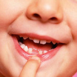 Süt Dişlerinde Renk Değişikliği