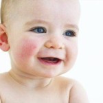 Egzama Nedenleri, Nasıl Anlaşılır ve Tedavisi?