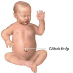 Göbek Fıtığı