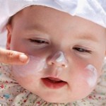 Çocuklarda Güneş Yanığı Nedir?