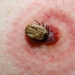 Kene Vücuttan Nasıl Çıkarılır ?