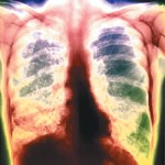 Çocuklarda Tüberküloz